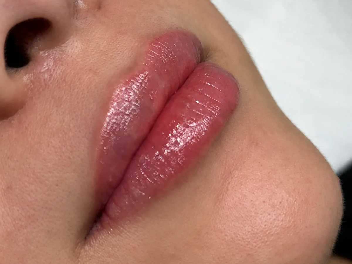 Labios de una clienta de MOSS después de relleno dérmico